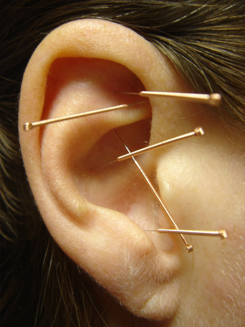 acupuncture for weight loss